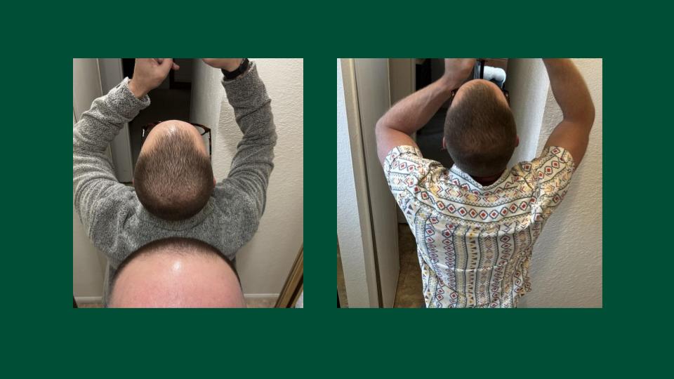 Exosome Hair Restoration Results